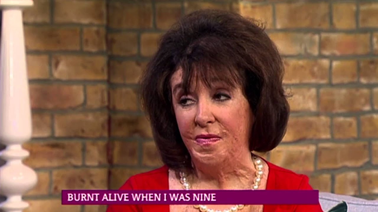 Burned Alive When I Was Nine | This Morning