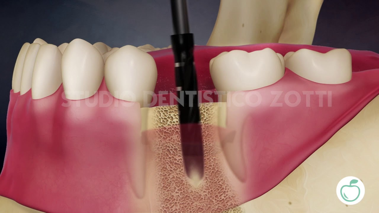 Impianto Dentale, Cos'&egrave; e come funziona
