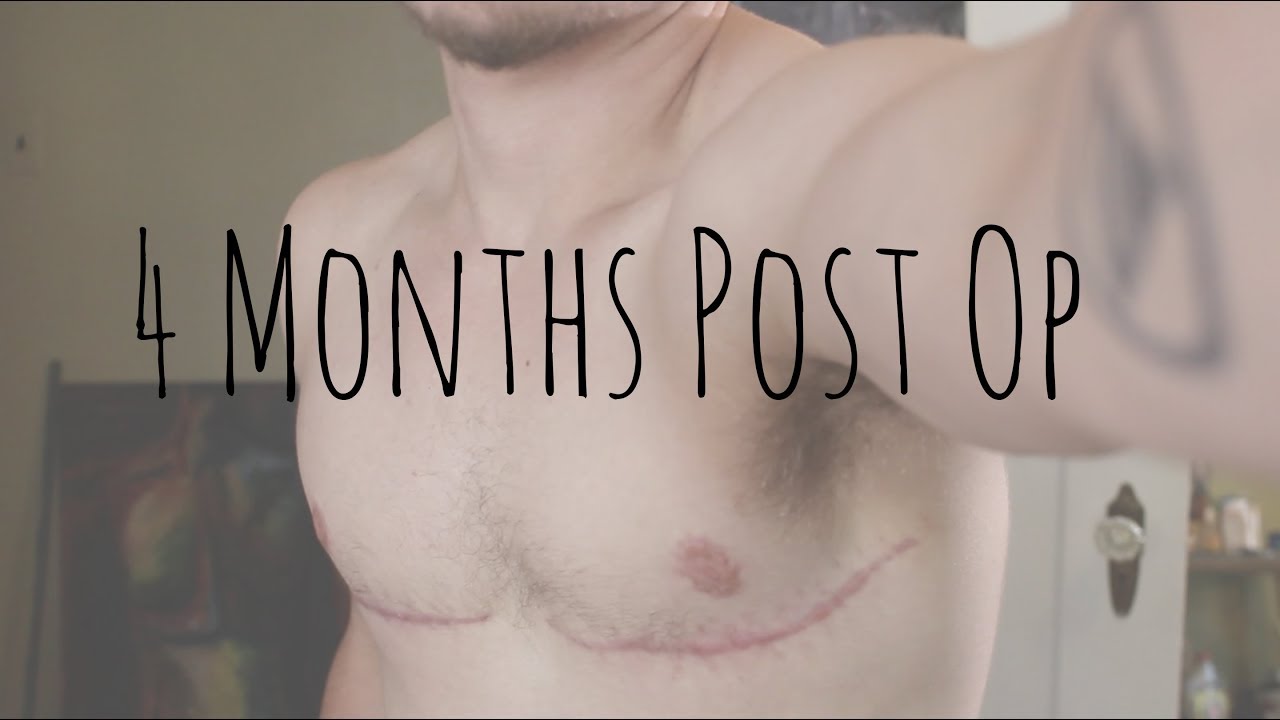 Top Surgery - 4 Months Post OP