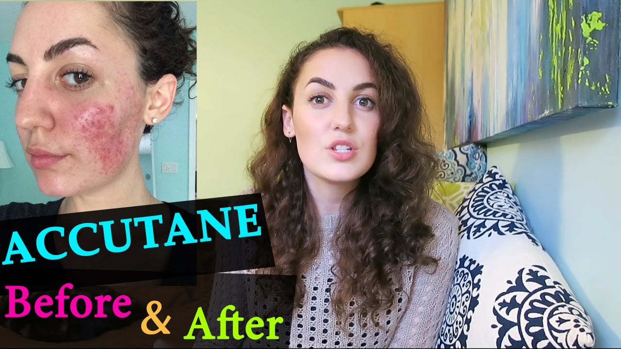 ACCUTANE BEFORE & AFTER // My Accutane Experience