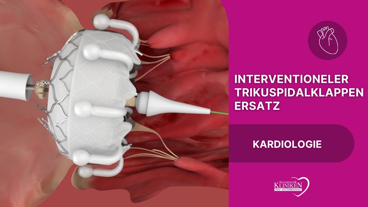 Interventioneller Trikuspidalklappenersatz - Moderne Therapie bei komplexen Klappenerkrankungen