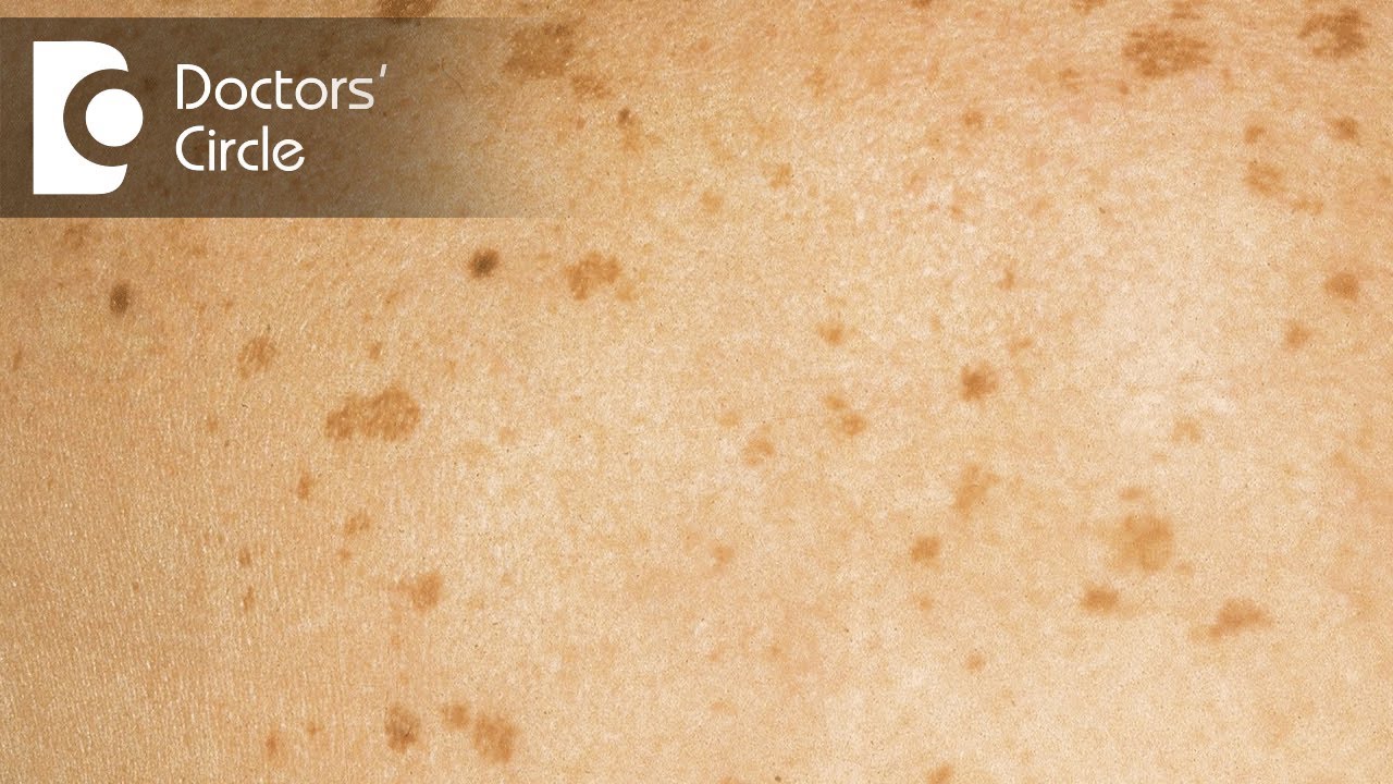 What causes black & brown skin lesions? - Dr. Rasya Dixit