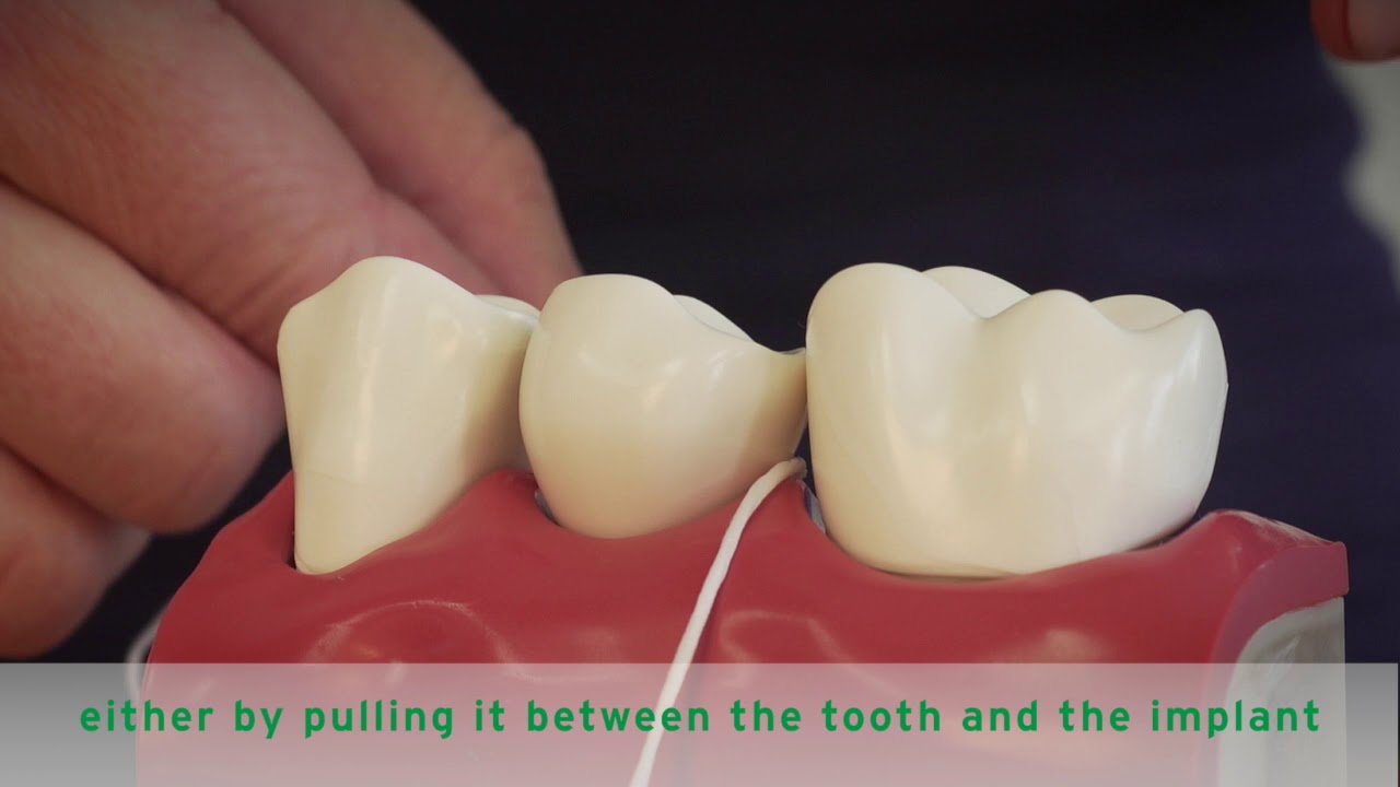 HOW TO FLOSS IMPLANTS