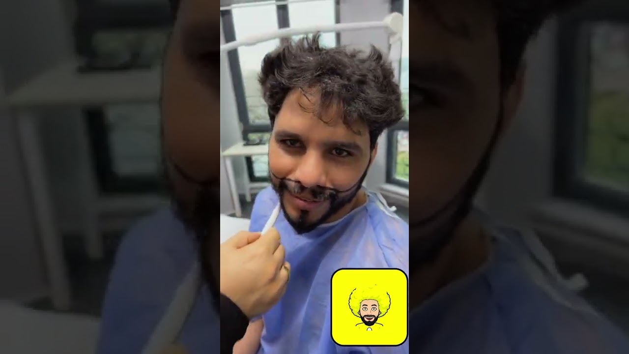 ‏زراعة الدقن قبل وبعد￼