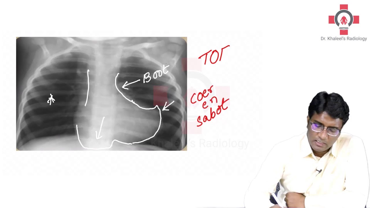 Tetralogy of Fallot | Radiology