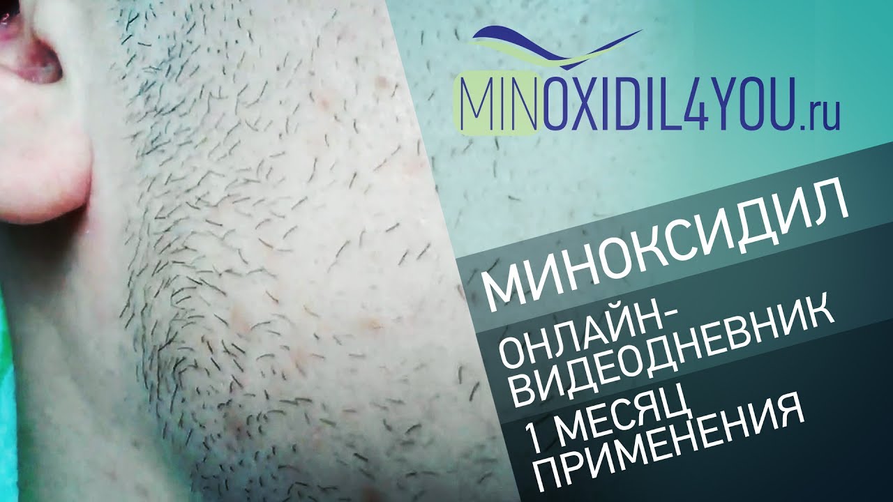 Миноксидил для волос и бороды. Онлайн-видеодневник 1 месяц применения миноксидила. Minoxidil4you