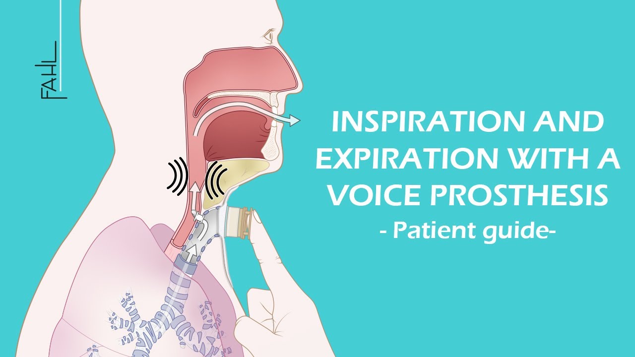 Inspiration and expiration with a voice prosthesis | Animation | Fahl Medizintechnik-Vertrieb GmbH