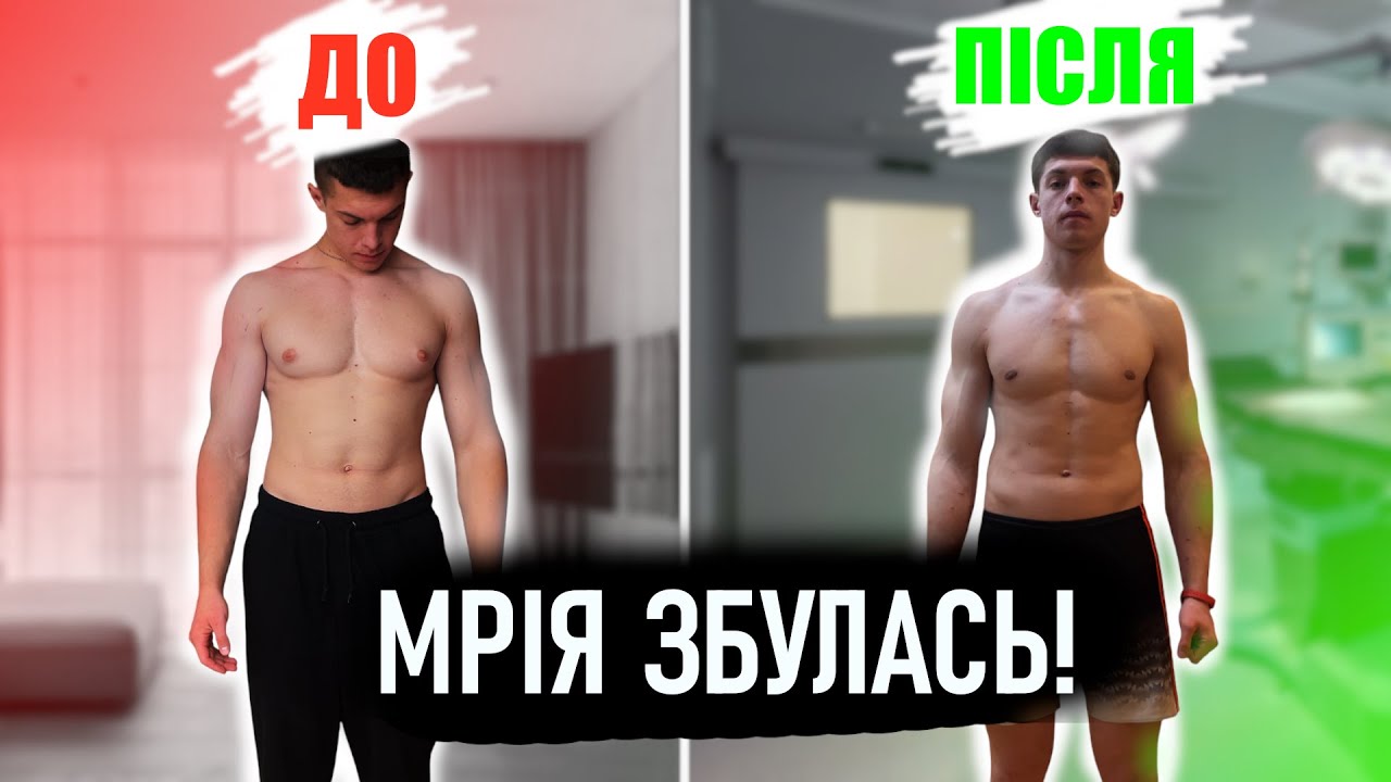 Гінекомастія | МОЯ ОПЕРАЦІЯ