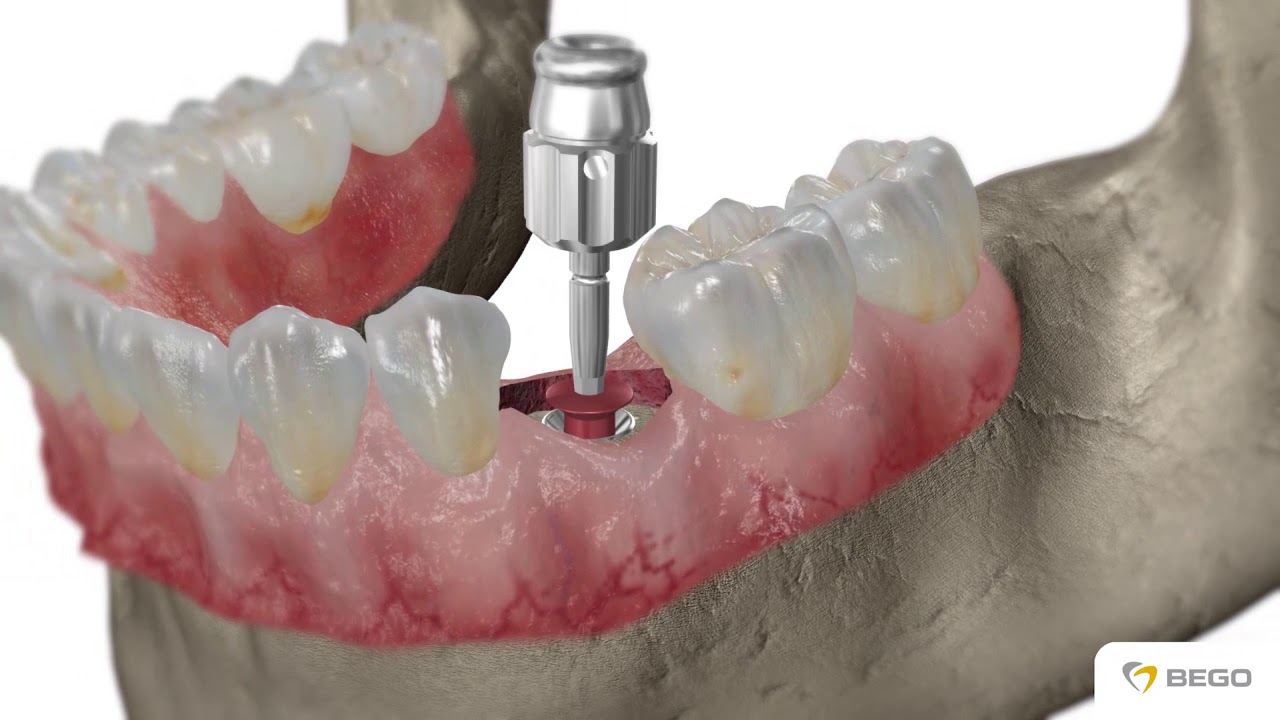 BEGO Semados® SC/SCX-Implantate / implants