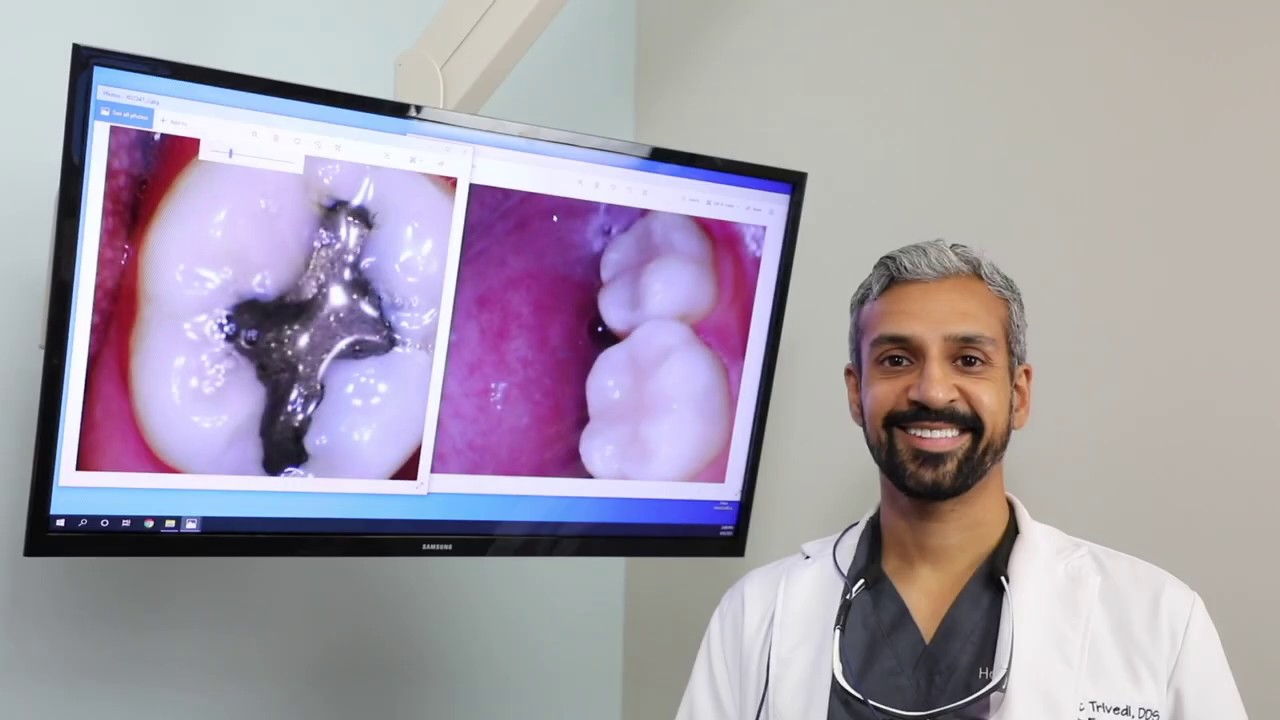 Mercury vs. Ceramic Fillings