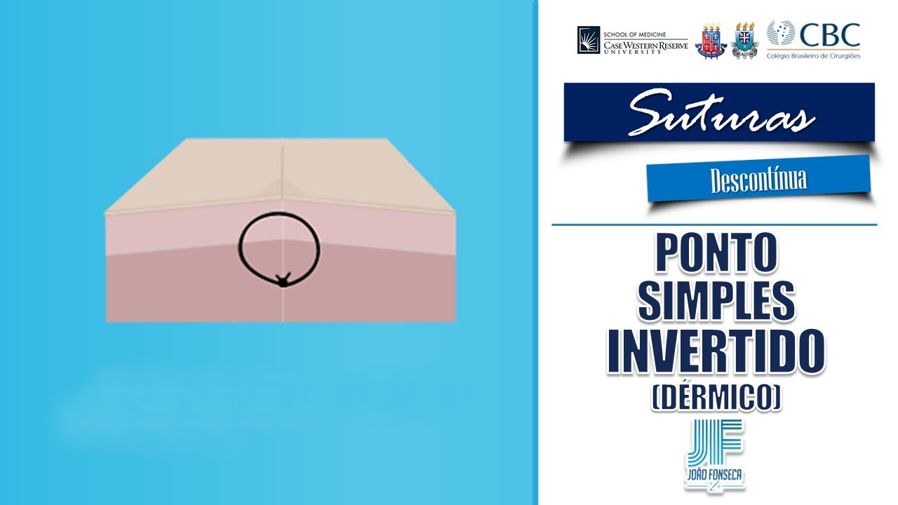 🪡SUTURAS – PONTO SIMPLES INVERTIDO (DÉRMICO)