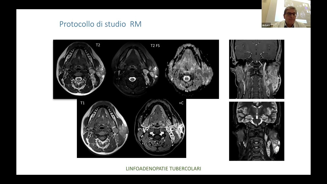 Patologia flogistica, oncologica e infettiva del collo - Prof. Arturo Brunetti, Prof. Lorenzo Preda