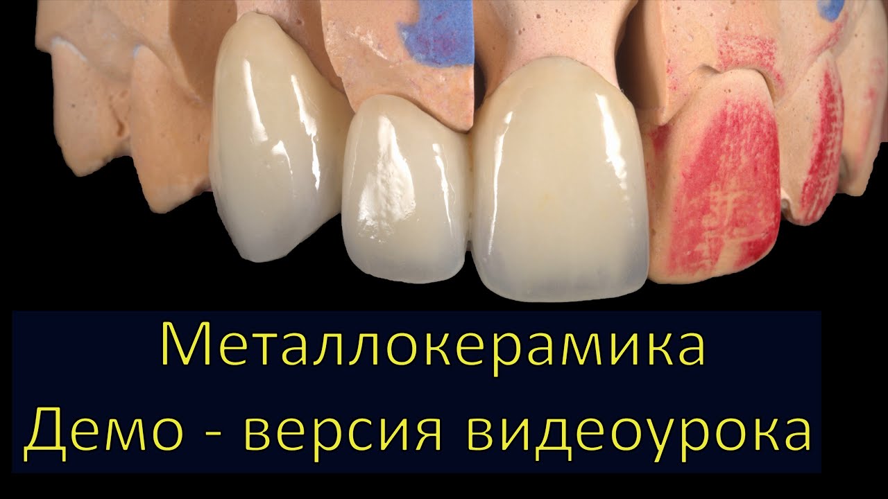 Металлокерамика inline. miyo. нанесение керамики. Изготовление зубов, Резец, клык.
