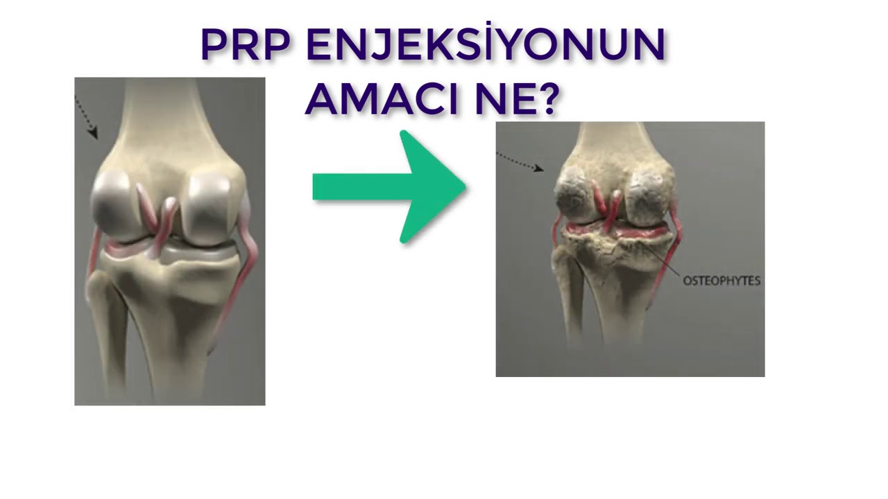 PRP? ГИАЛУРОНОВАЯ КИСЛОТА? КОРТИКОСТЕРОИД? НЕ ДЕЛАЙТЕ ИНЪЕКЦИЮ БЕЗ ПОСМОТРА ЭТОГО ВИДЕО!