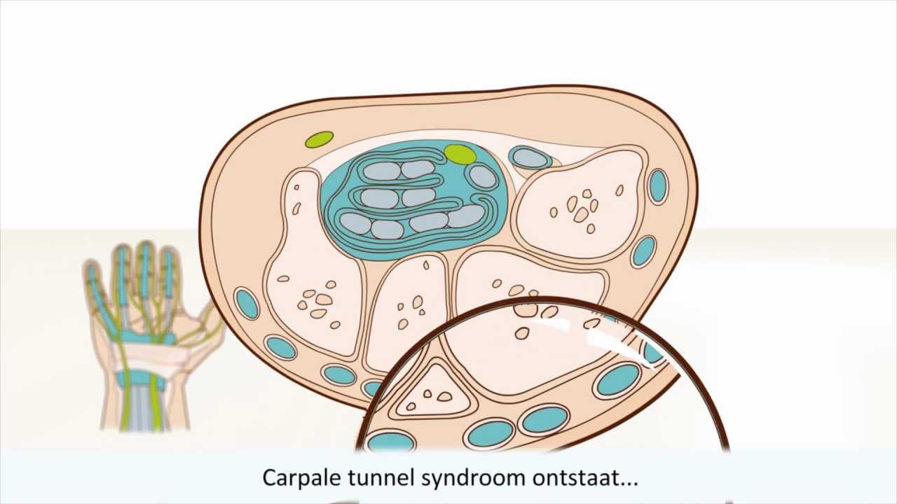 Carpale tunnel syndroom (CTS) - symptomen en behandeling