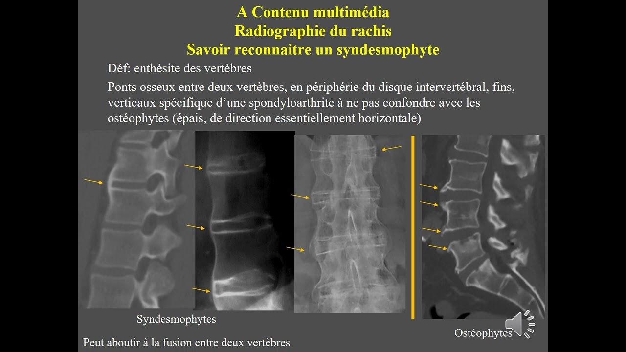 Spondylarthrite - CERF