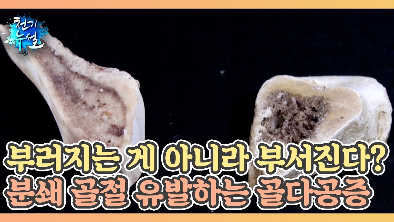 부러지는 게 아니라 부서진다?! 분쇄 골절 유발하는 골다공증 MBN 230203 방송
