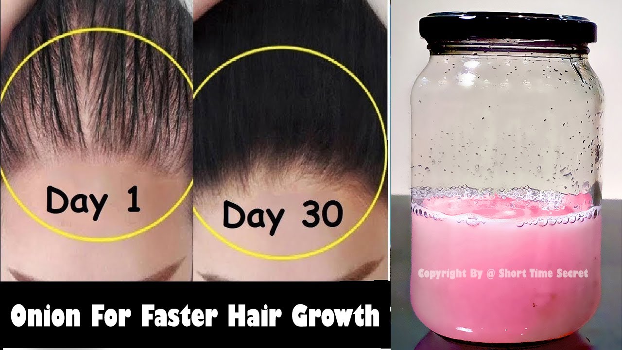 How To Use Onion Juice For Extreme Hair Growth - 15 Days Challenge for Longer and Thicker Hair