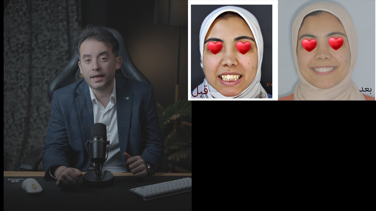 ⭐ تحول ابتسامة مذهل | علاج ازدحام شديد وعضة معكوسة بدون جراحة – قبل وبعد