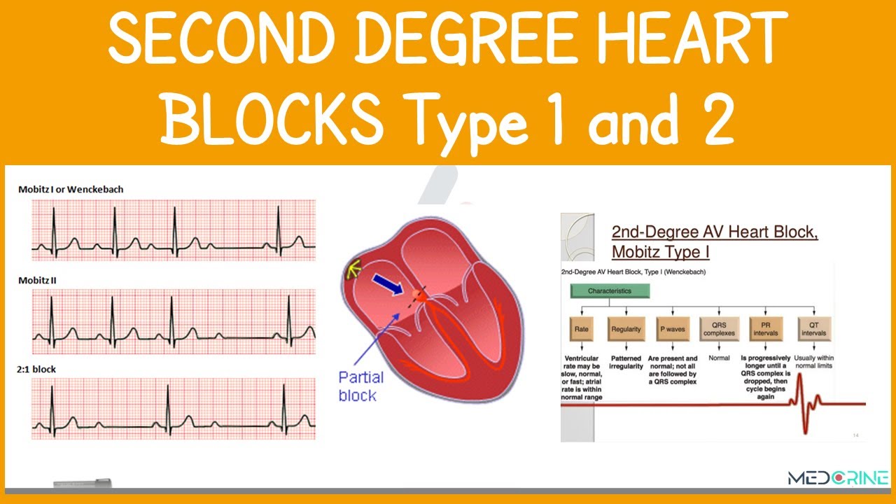 Second Degree Heart Block | Mobitz I & II ECG Interpretation Simplified