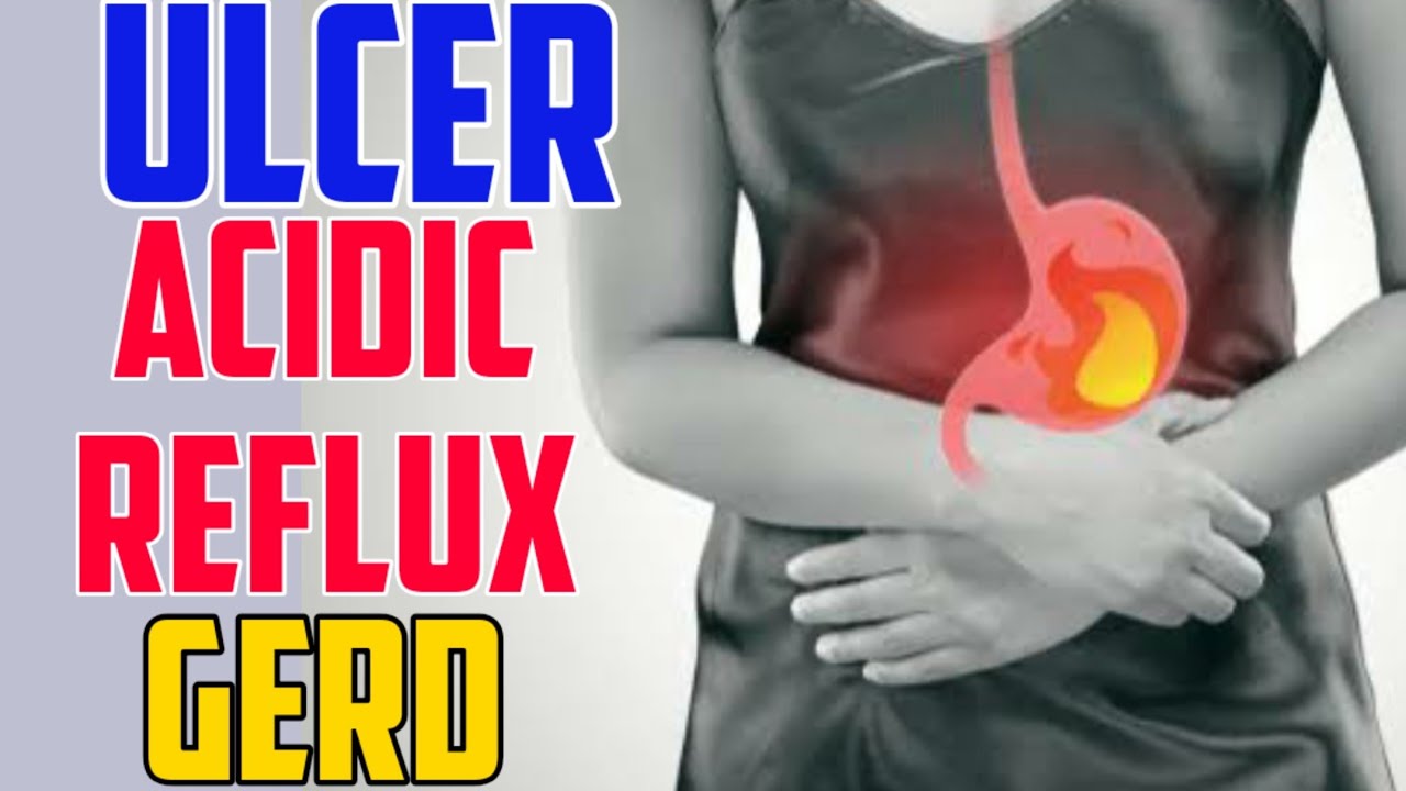 Ulcer, Acidic Reflux, GERD - ni Doc Willie Ong #287b