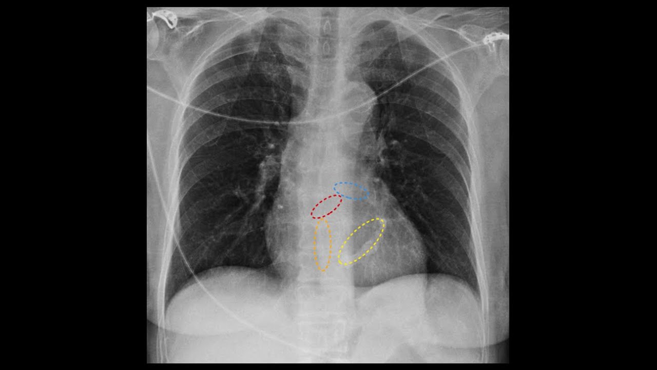 Calcificação do anel mitral