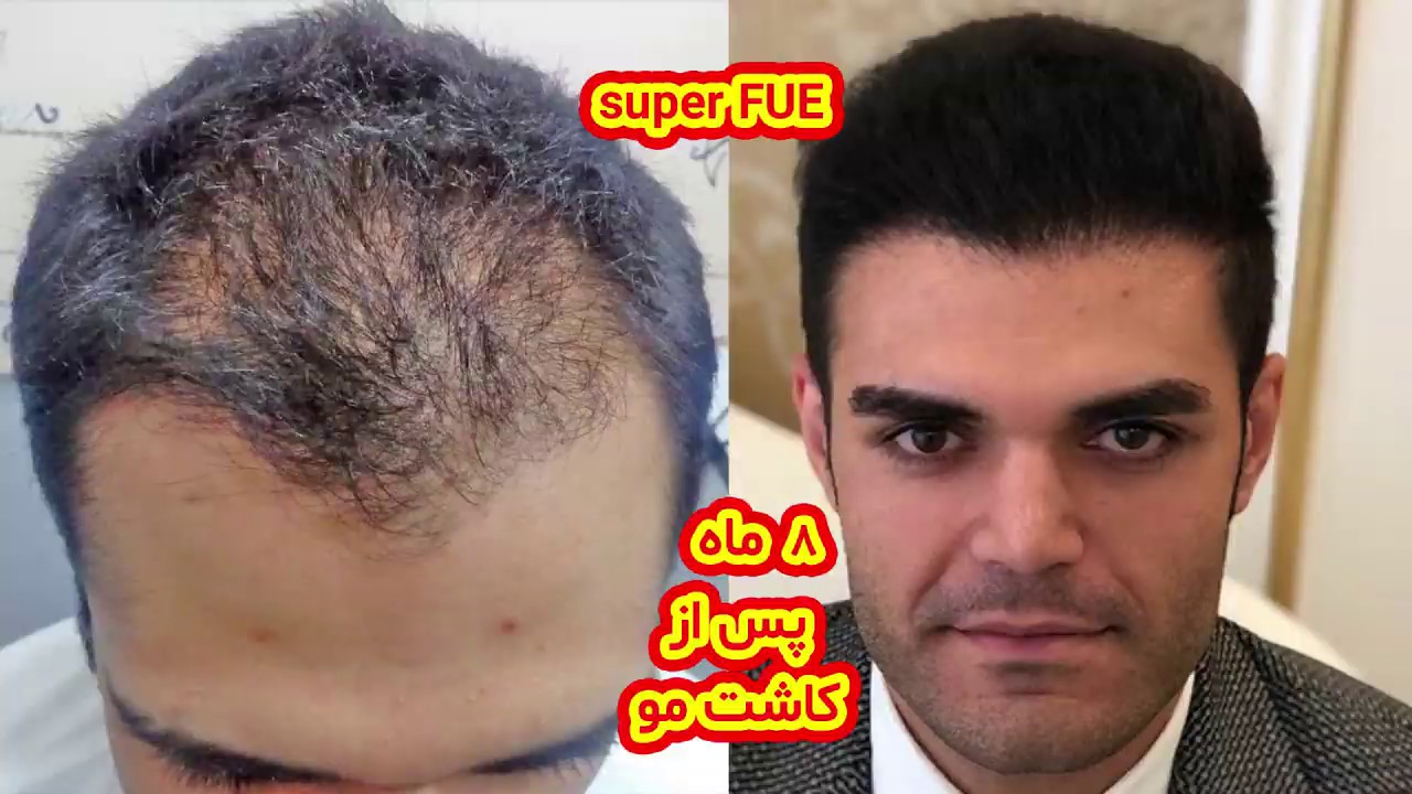 مصاحبه با یکی از مراجعه کنندگان کاشت مو بعد از گذشت 8 ماه|کلینیک رایان سلامت