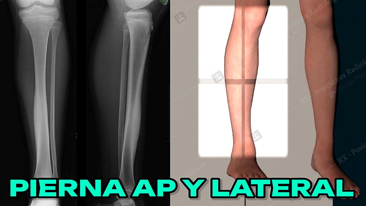 RADIOGRAFÍA DE PIERNA AP Y LATERAL (MANUAL DE BOLSILLO) #17