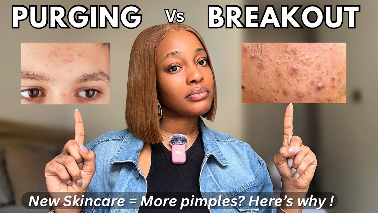Still Breaking out? How to Tell if it’s Acne purging or a Real breakout