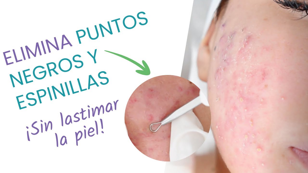 Aprende CÓMO QUITAR los puntos negros y espinillas | De forma FÁCIL y SIN DAÑAR LA PIEL