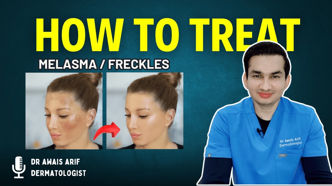 Melasma vs. Freckles: Key Differences & Best Treatment Options | Dr. Awais Arif
