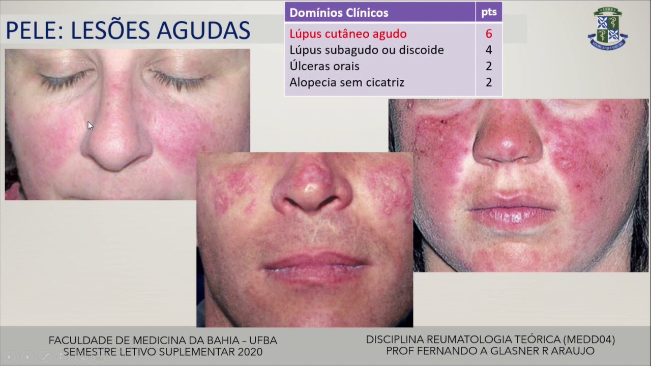 Lúpus Eritematoso Sistêmico, 2020