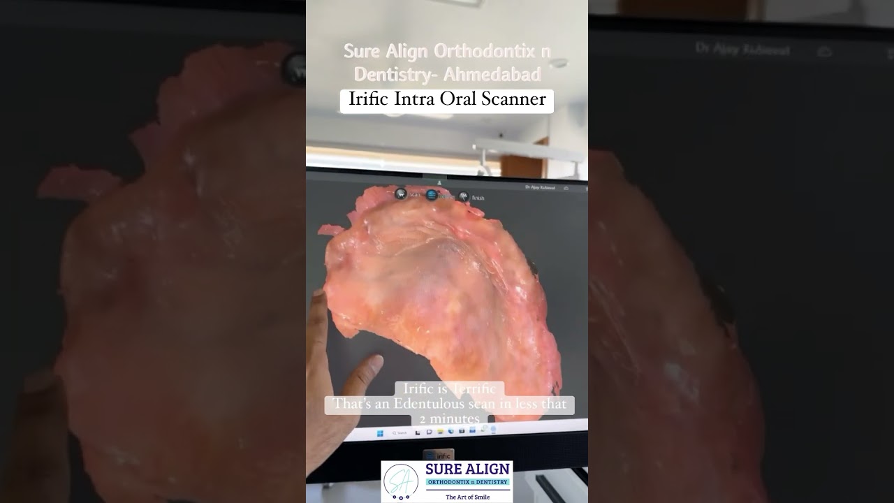 Intra oral scanning of soft tissue. Edentulous Maxilla Scan with Irific Scanner.