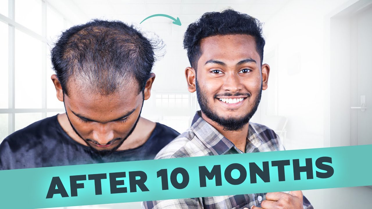 Month-by-Month Hair Transplant Results 😀 | Bangladesh | New Roots