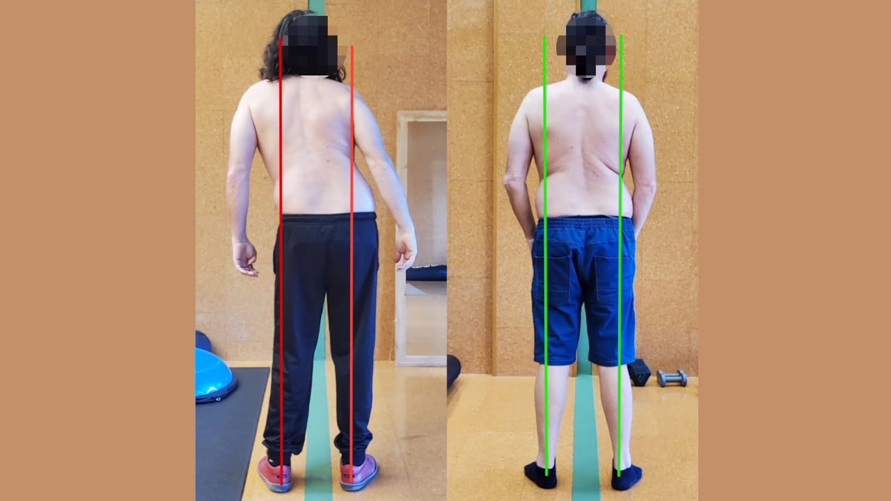 Progresos de Postura de Cifosis y Escoliosis con hernias y pinzamientos