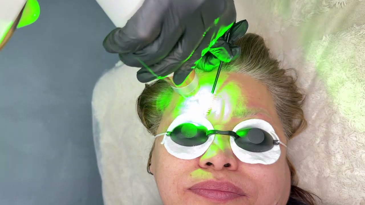 Picosecond laser machine / Orange eyebrow tattoo removal full processes