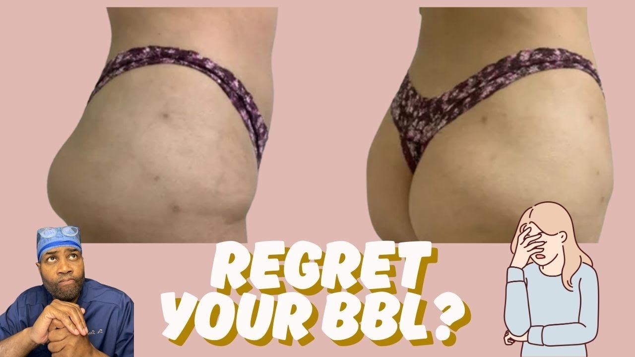 Thinking About BBL Reversal? 5 Must-Know Truths for Women