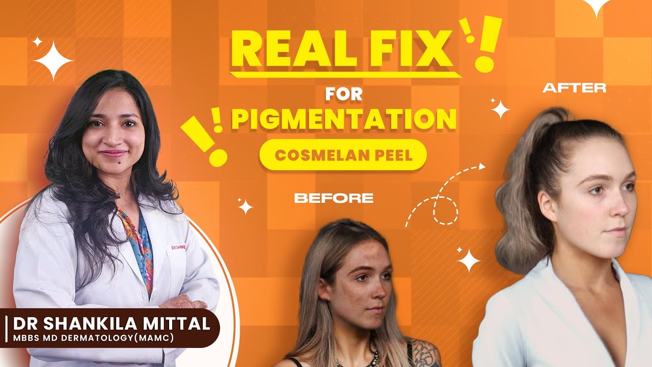Cosmelan Peel for Pigmentation, Melasma & Acne Scars | Benefits, Usage & Real Results