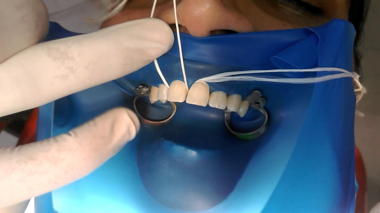 How to secure and uplift rubber dam sheet with the help if floss knot tie