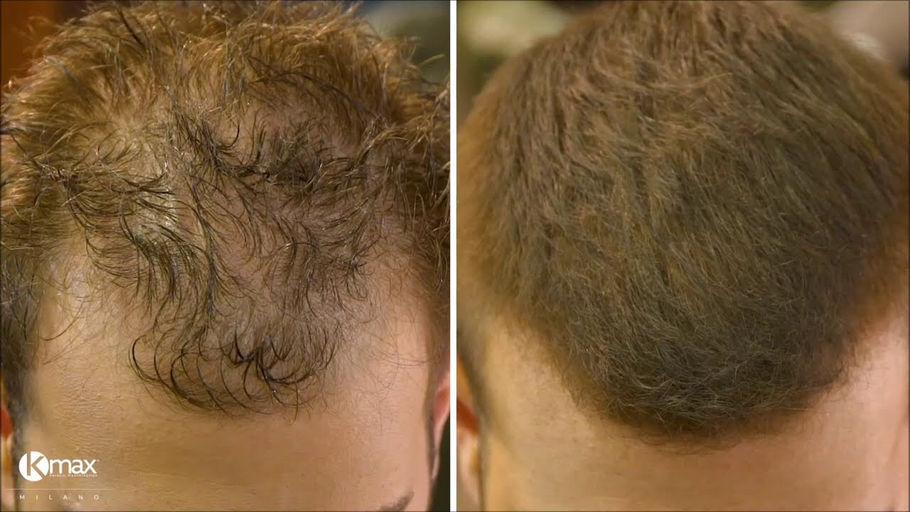 KMax hair fibers, ί&nu;&epsilon;&sigmaf; &pi;ύ&kappa;&nu;&omega;&sigma;&eta;&sigmaf; &mu;&alpha;&lambda;&lambda;&iota;ώ&nu;