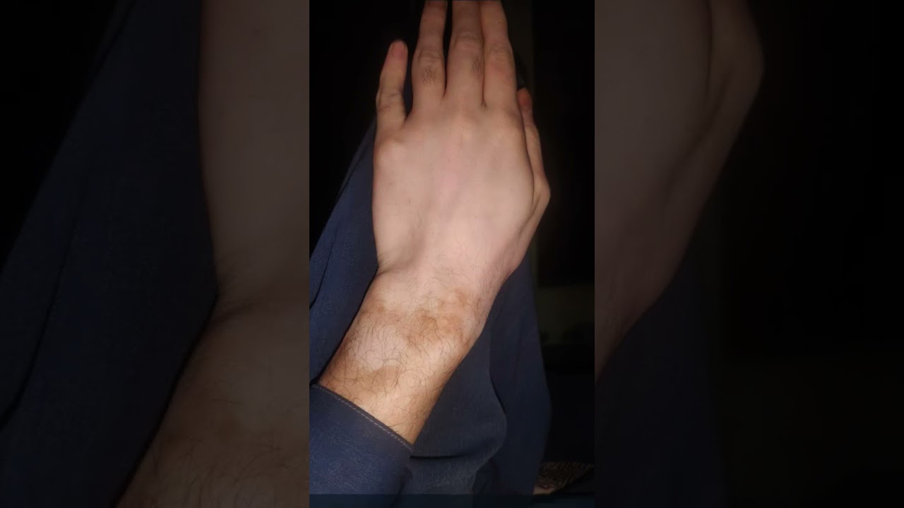 vitiligo treatment using monobenzone cream