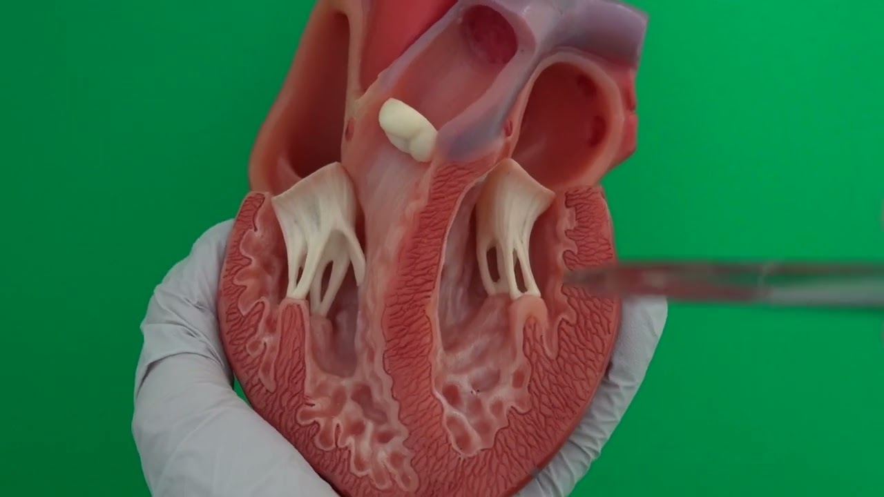 Trabeculae Carneae, Papillary Muscles, Chorda Tendineae in the Ventricles
