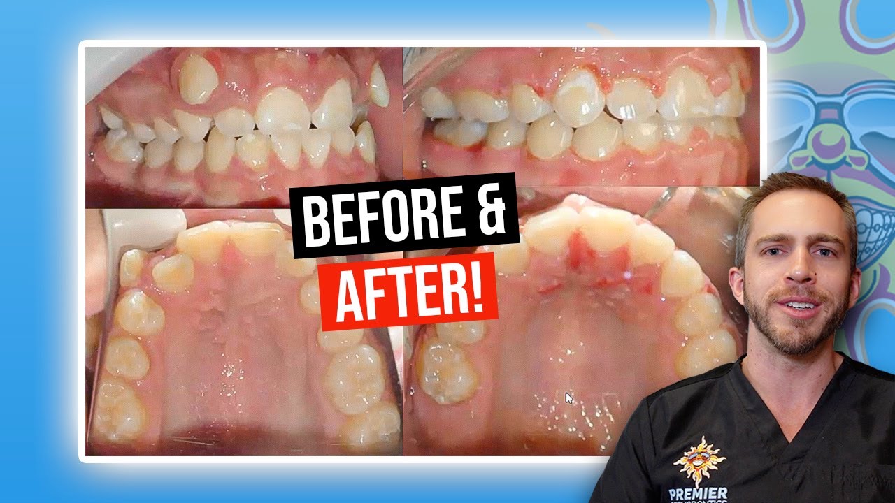 BRACES BEFORE & AFTER: Crowding with Missing Teeth