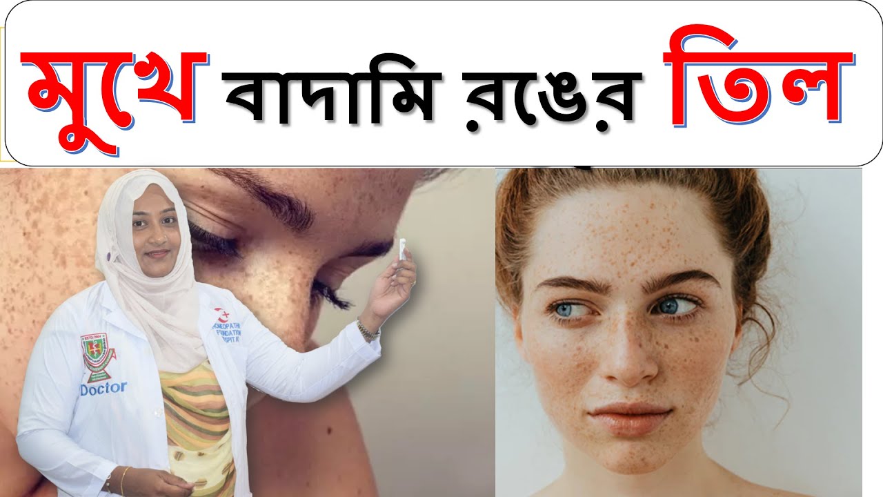 মুখে বাদামি রঙের তিল | Freckles treatment | Bangla health tips | ডাঃ শামীমা নাসরীন দিনা