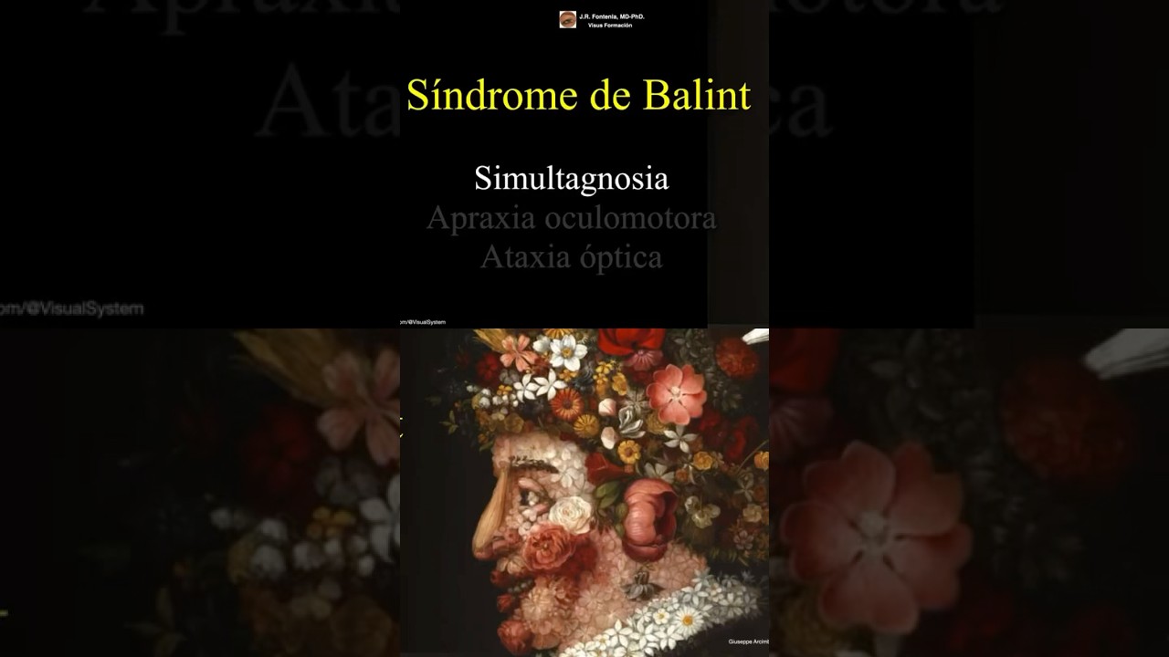 Simultagnosia. S&iacute;ndrome de Balint. #agnosia #neurologia #optometria #ceguera