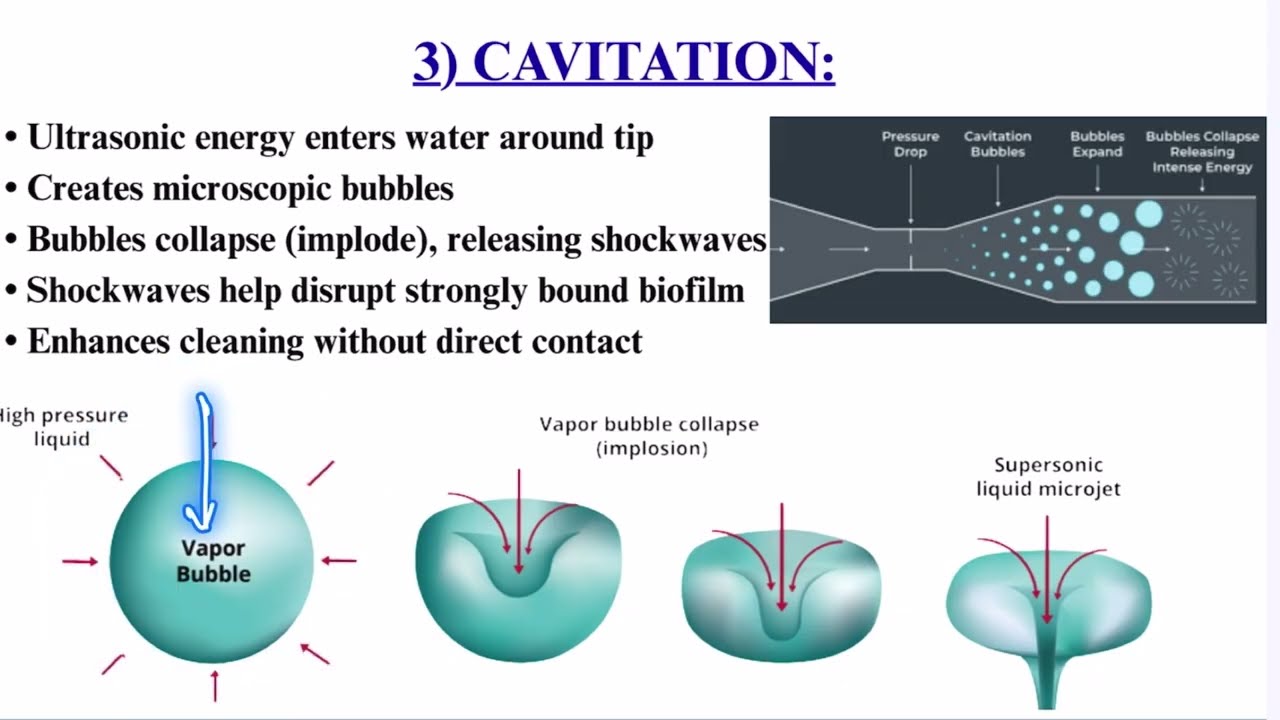ultrasonic scalers, part 3 Ultrasonic Periodontal Debridement mechanism of action