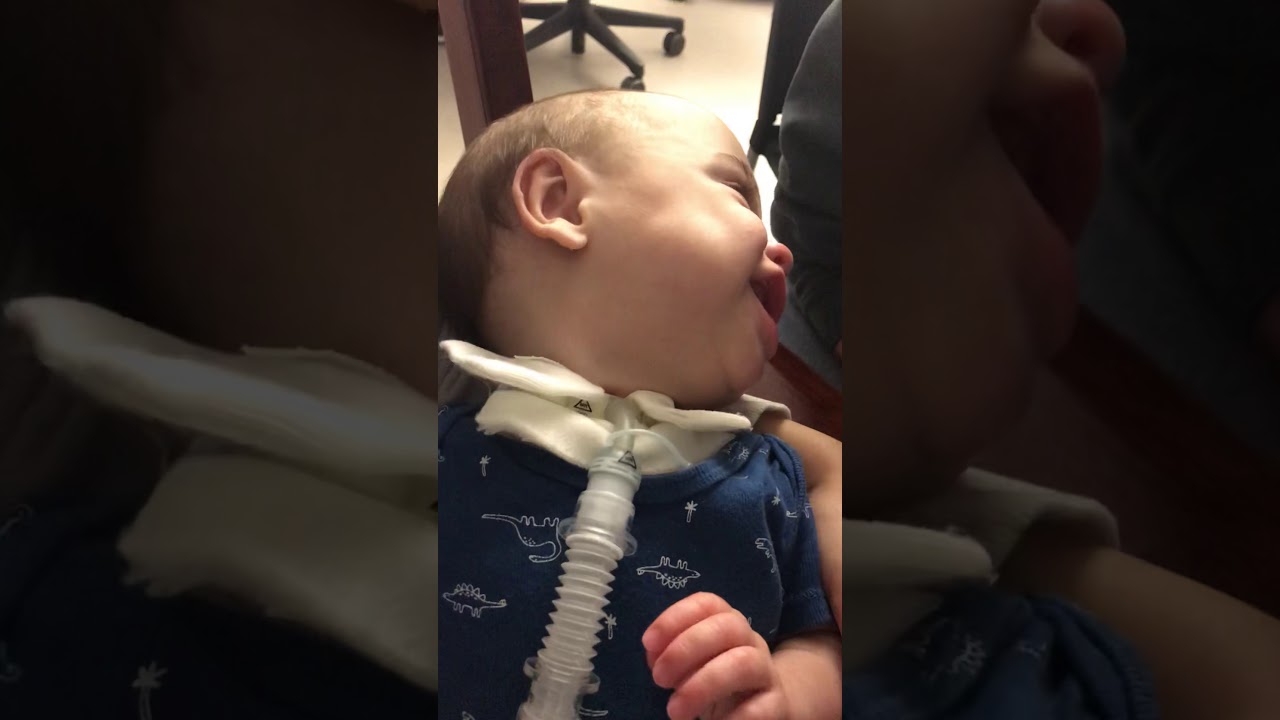 24 week micro preemie now 1 year old trach/vent baby