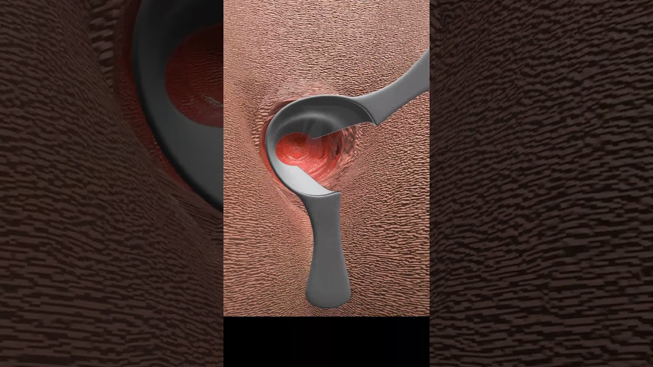 Why Do I Need Fistula Surgery? #shorts #fistula
