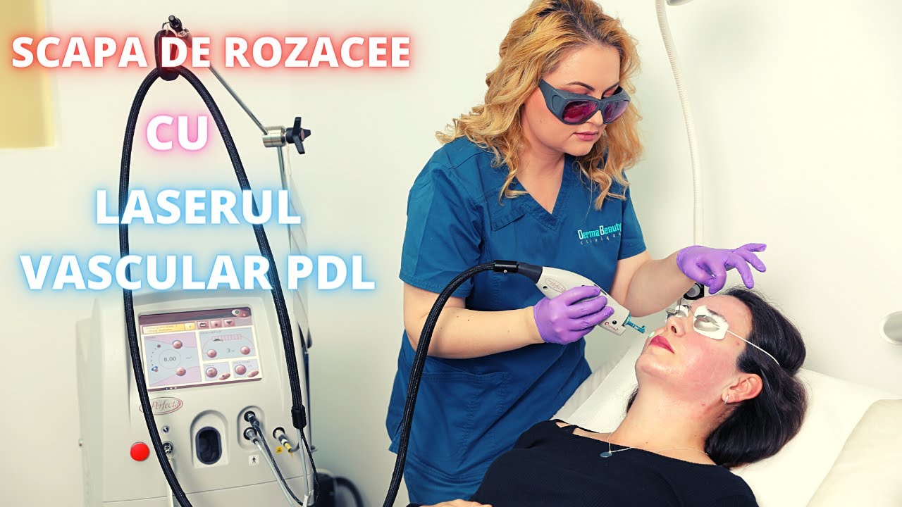 Scapa de Rozacee cu Laserul Vascular PDL Vbeam | Testimonial pacient