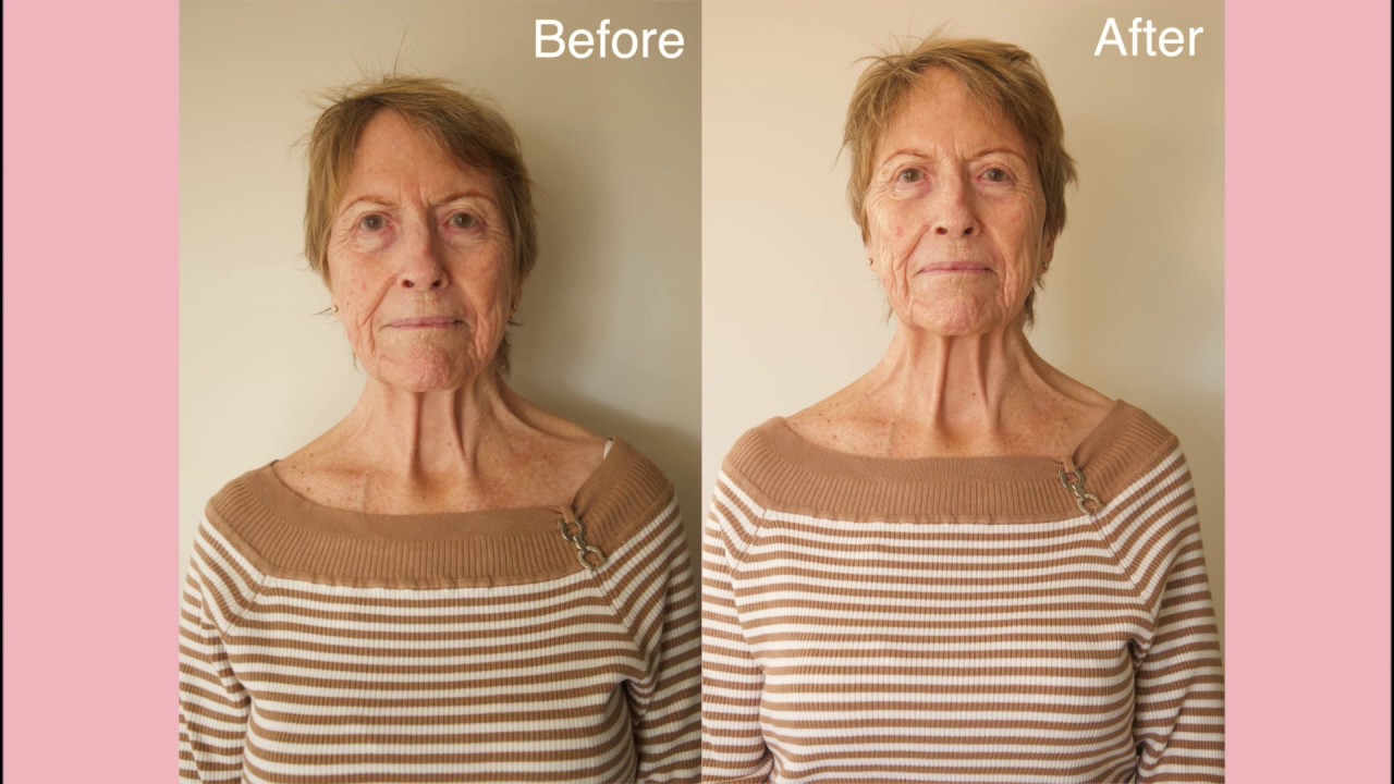 PlasmaPen Facial Treatment - Promotional Video | The Facial Architect | Alannah Jade